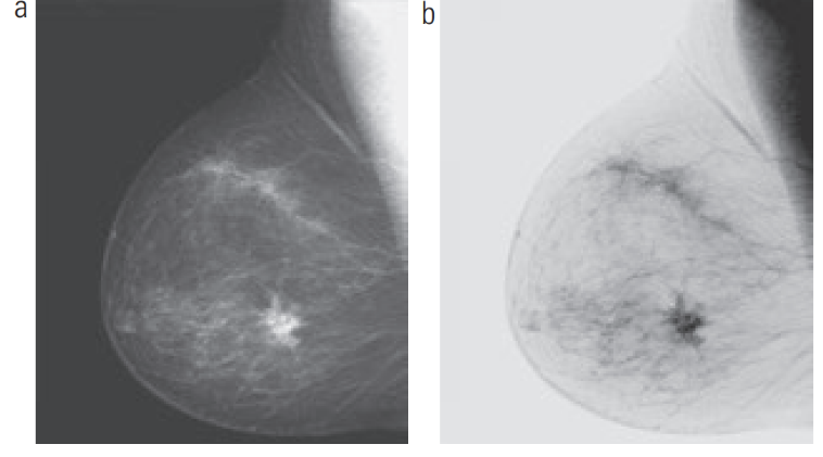 Transformação Linear (Negativos de Imagens). (a) Mamografia digital original. (b) Negativo da imagem. [2, p. 71].